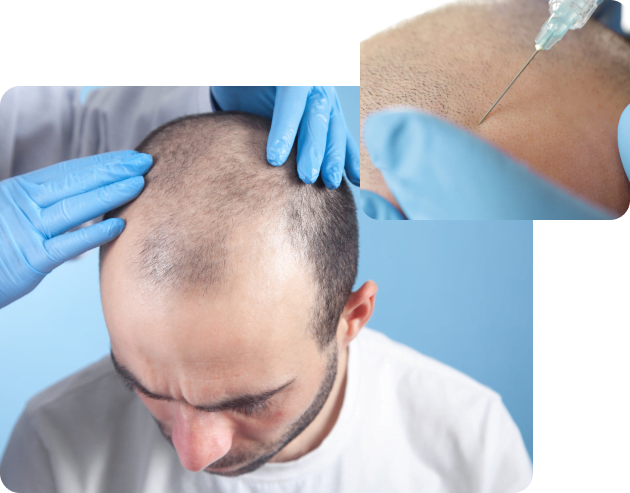 Top Symptoms of Androgenetic Alopecia