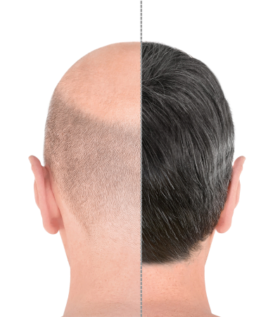 Hair Restoration Cost