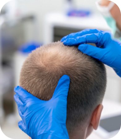 Is Rogaine® Effective for Restoring Hair Loss?