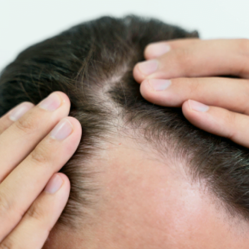Can My Alopecia be Cured?