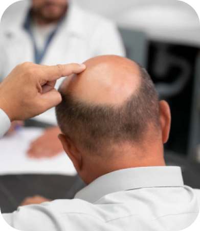 5 Important Things to Know About Hair Transplants