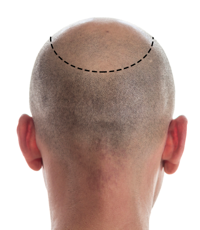 Hair Loss Causes