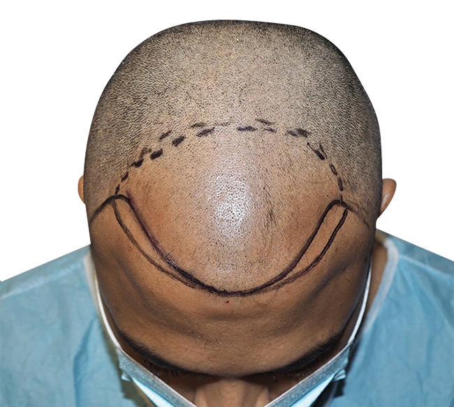 What is a Hair Transplant?