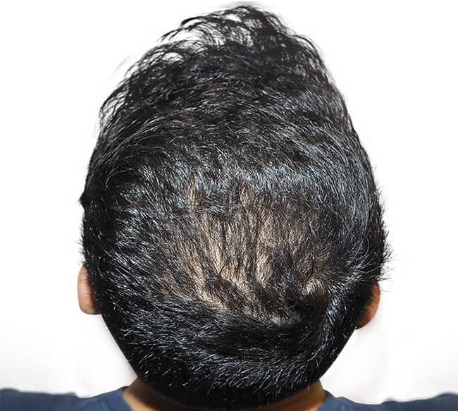 5 Benefits of FUE Hair Restoration