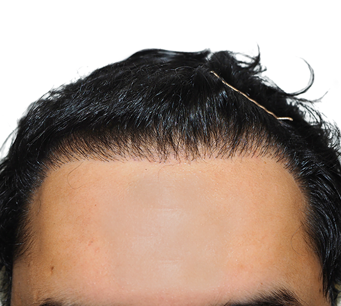 hair transplant florida