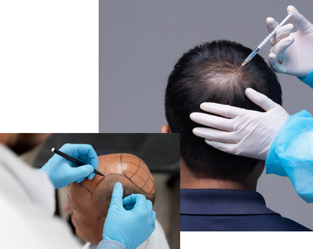 Is There a Best Age to Get a Hair Transplant?