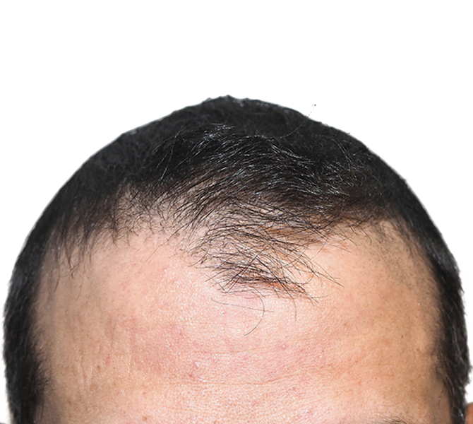 Am I a Good Candidate for Follicular Unit Extraction?