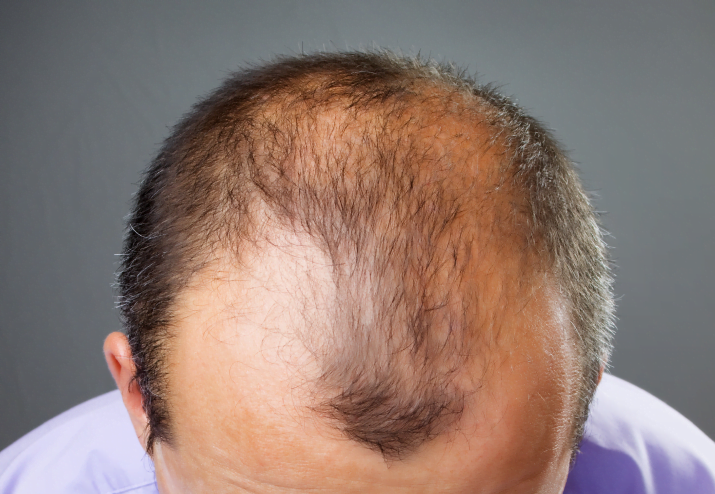 5 Common Causes for Hair Loss in Men