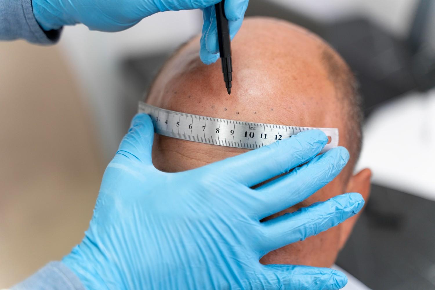 FUE and FUT hair transplant Florida